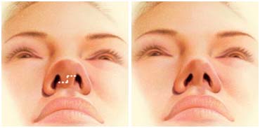 Rhinoplasty Nose Medical Treatment Kolkata India, Rhinoplasty Nose Surgery Cost India, Rhinoplasty Nose Surgery Price